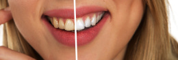 Opalescence PF żel do wybielania zębów 4 szt. + nakładka termoformowalna